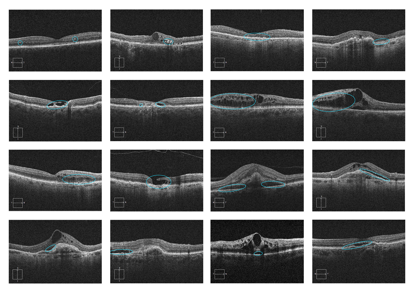 Interpret macular oct eyecarepd