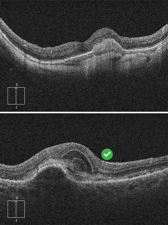 Active Choroidal Neovascularization Vs. Inactive CNV And Or Scar ...