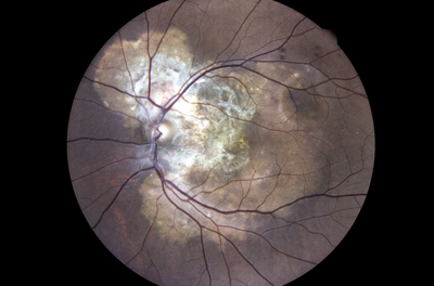 Atlas of Retinal Disease