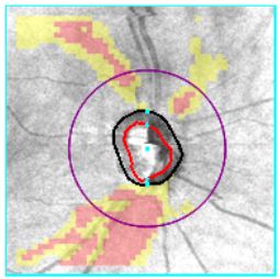 Macular OCT Interpretation: Course 101