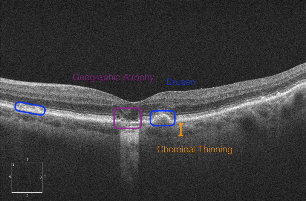 Dry Age-Related Macular Degeneration - EyeCarePD