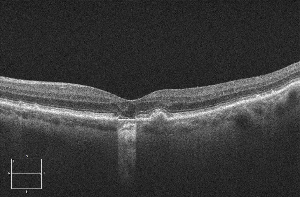 OCT Optical Coherence Tomography