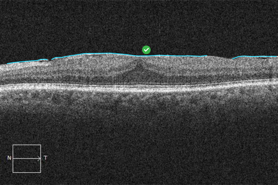 Oct Images Of Epiretinal Membrane