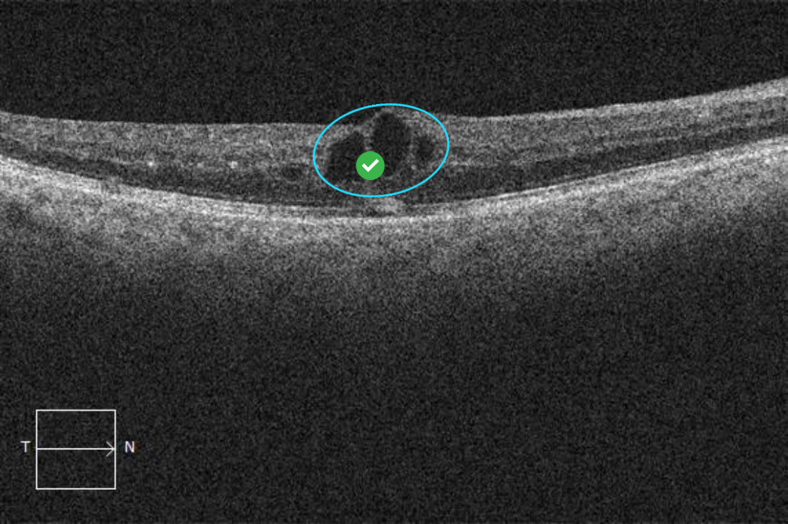 intraretinal-fluid-empty-cysts-eyecarepd