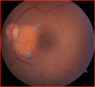 Choroidal Osteoma - EyeCarePD