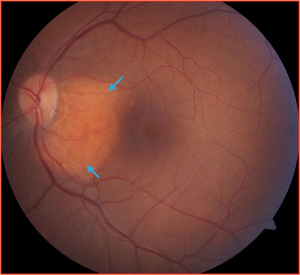 Choroidal Osteoma - EyeCarePD