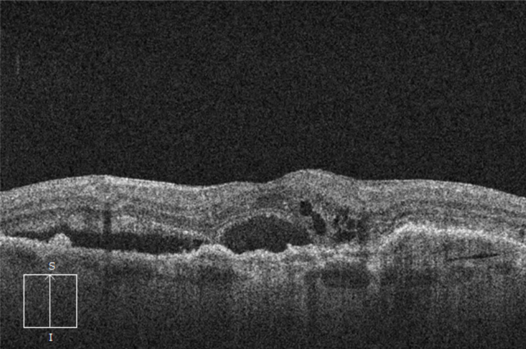 Keystone Exercises using Static Images
