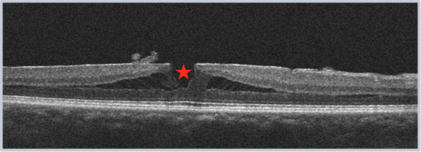 Buraco macular lamelar (LMH) - EyeCarePD