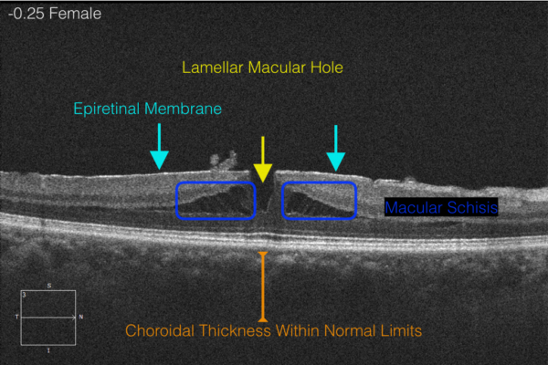 Lamellar Macular Hole - Labelled OCT - EyeCarePD