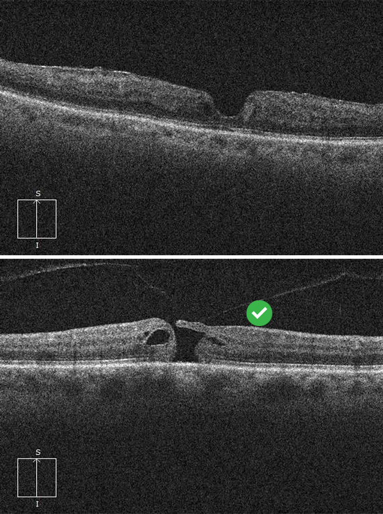 Lamellar Macular Hole Vs Full Thickness Macular Hole