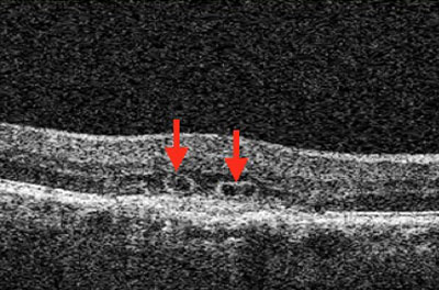 Macular OCT Glossary