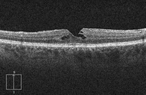 Macular OCT Interpretation Course 201 - EyeCarePD