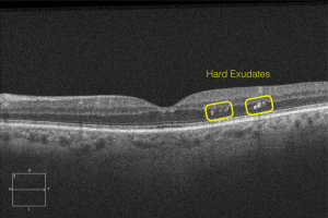 Nonproliferative Diabetic Retinopathy without Diabetic Macular Edema