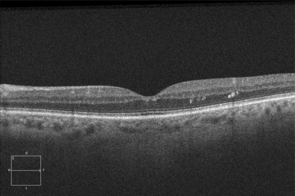 nonproliferative diabetic retinopathy without macular edema bilateral icd 10