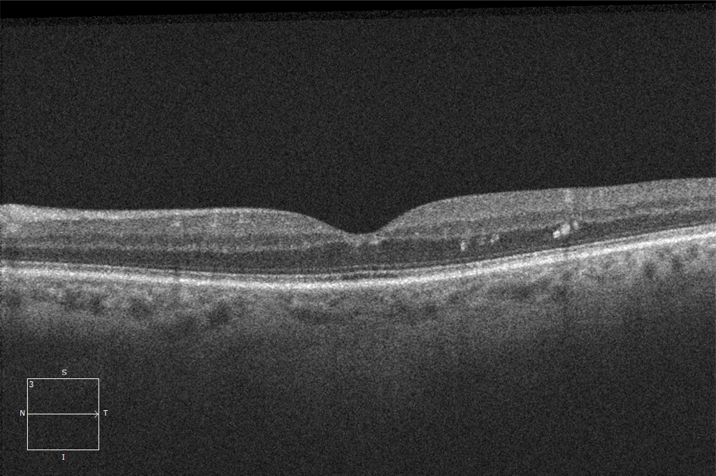 OCT Optical Coherence Tomography