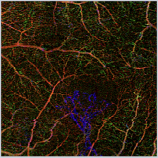 diseases-of-the-macula-2