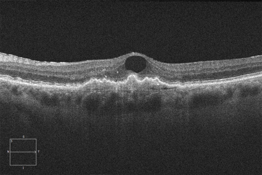 Cystoid Fluid Is it macular degeneration or a venous occlusion? EyeCarePD