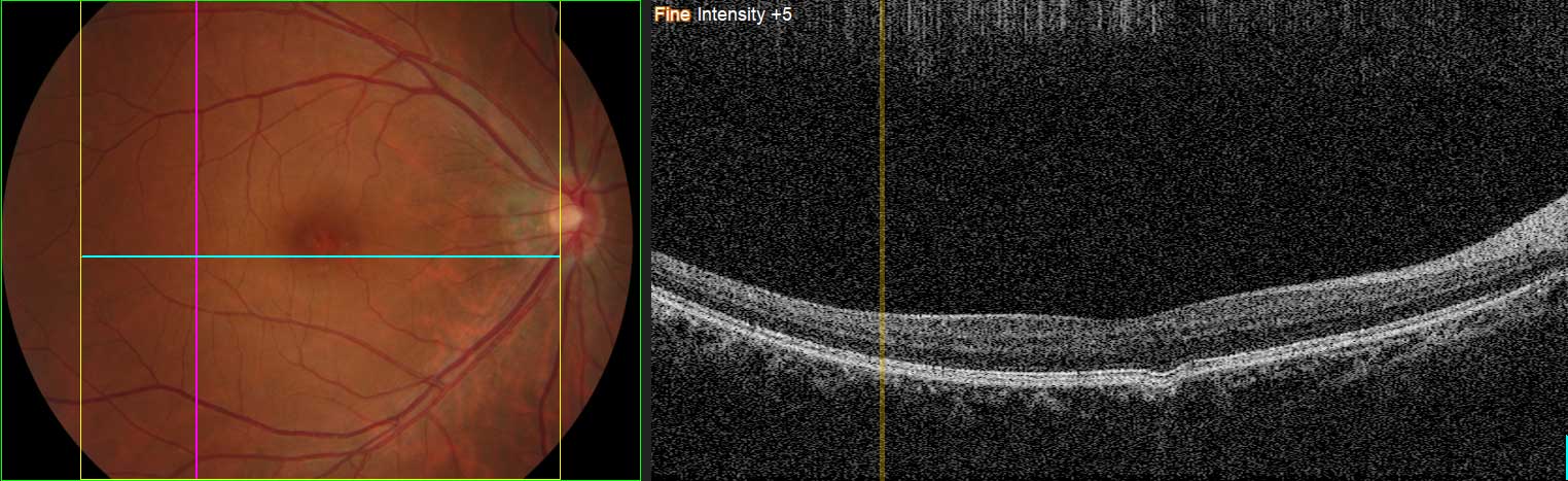 OCT Optical Coherence Tomography