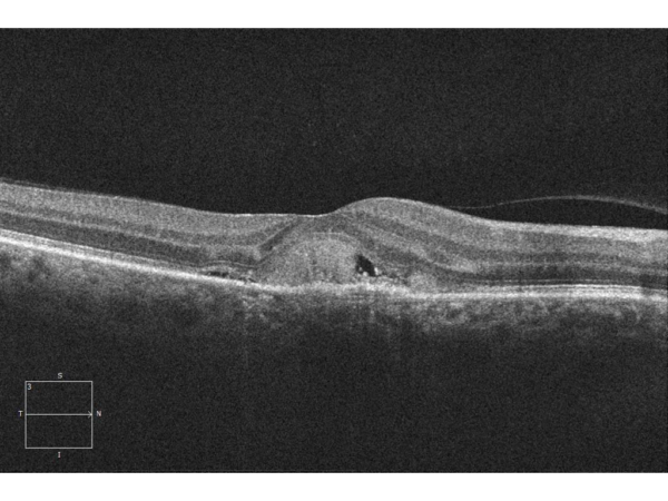 Age related macular degeneration что это