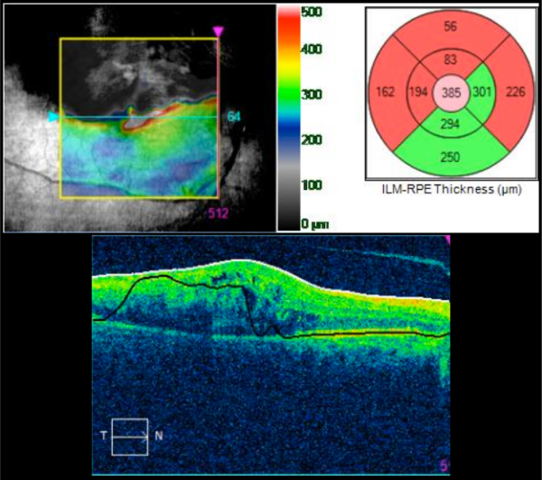 branch retinal vein occlusion without macular edema icd 10