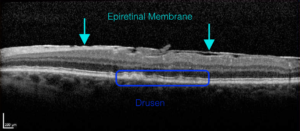 Epiretinal Membrane and Dry Age-Related Macular Degeneration - EyeCarePD
