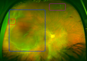 macula-off-rhegmatogenous-retinal-detachment-labelled - EyeCarePD