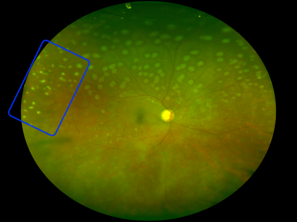 Panretinal Photocoagulation (PRP) - EyeCarePD